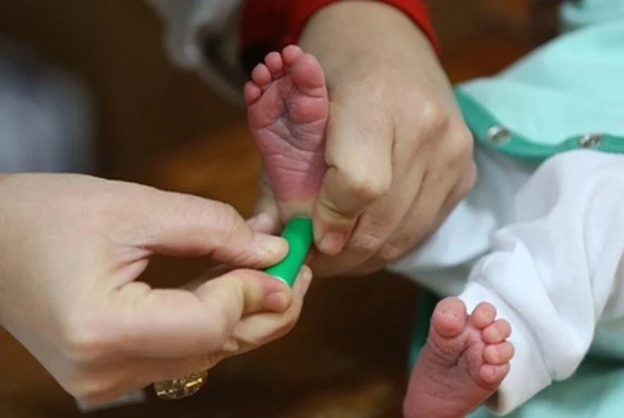 آزمایش تیروئید نوزاد 1 آزمایش تیروئید نوزاد