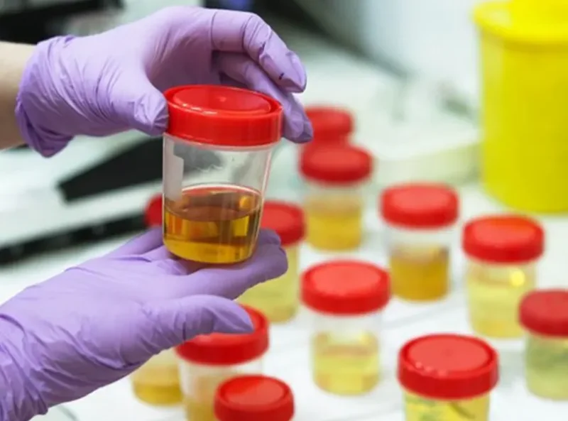 آزمایش ادرار