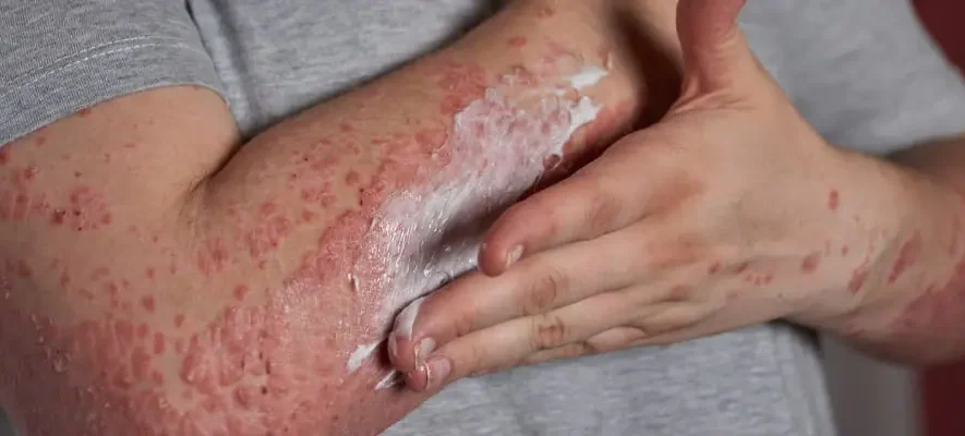 بیماری‌های خودایمنی