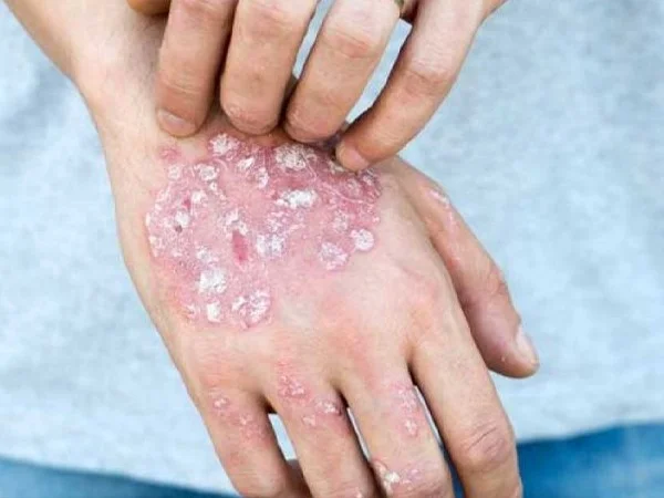 بیماری‌های قارچی و عفونی مزمن